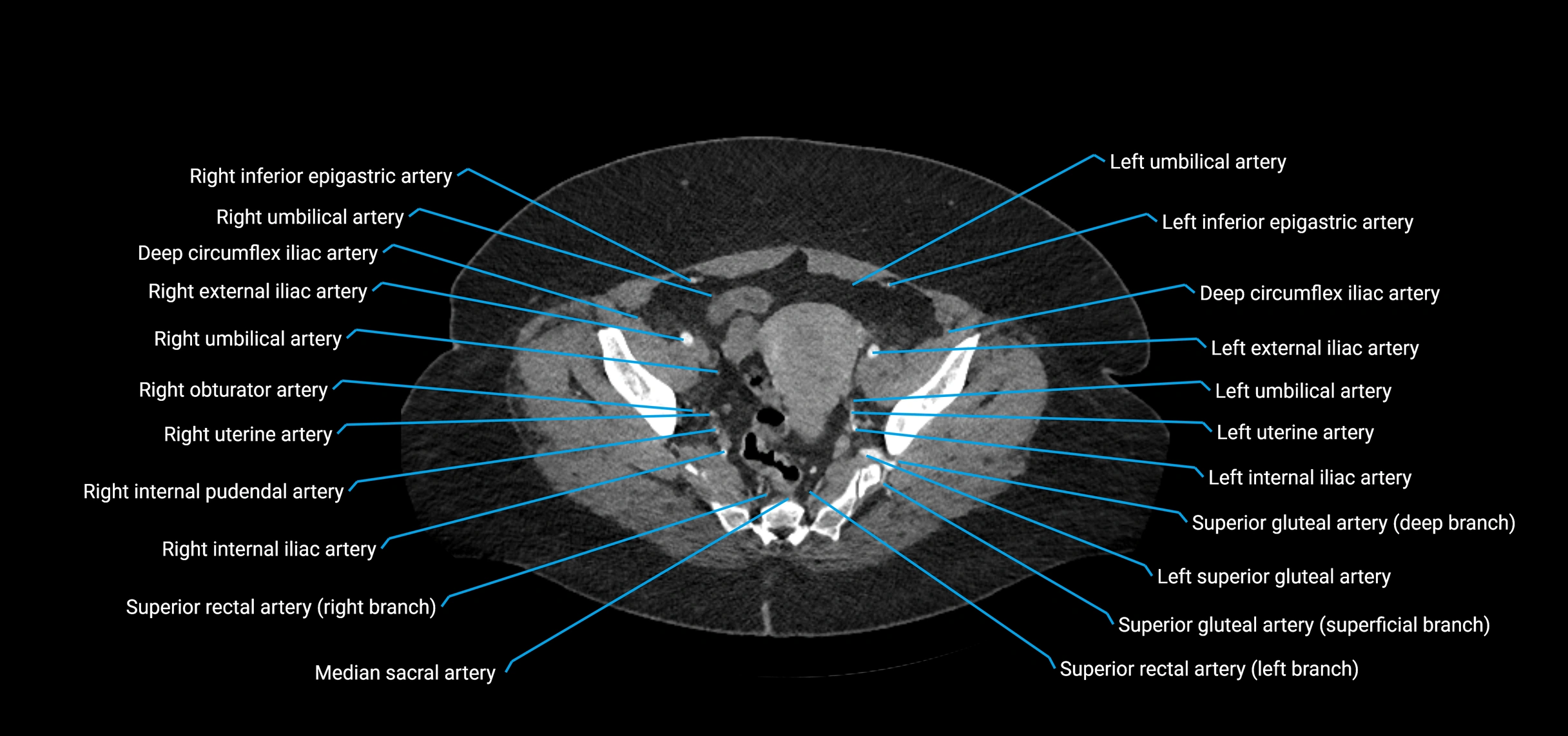 CTA abdomen axial cross sectional anatomy labelled image_214 (2).webp